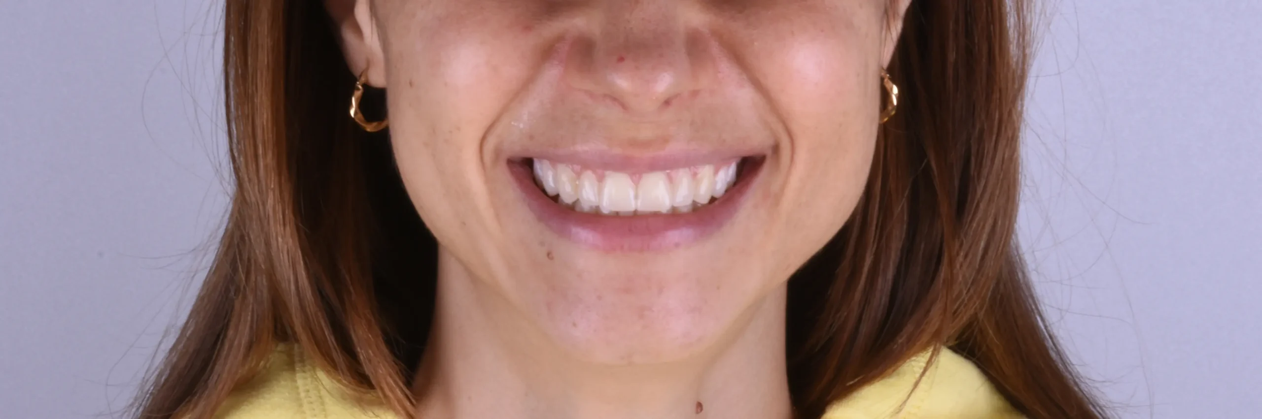 Sorriso depois do tratamento