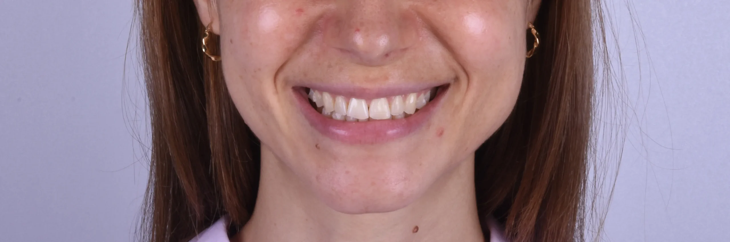 Antes del tratamiento