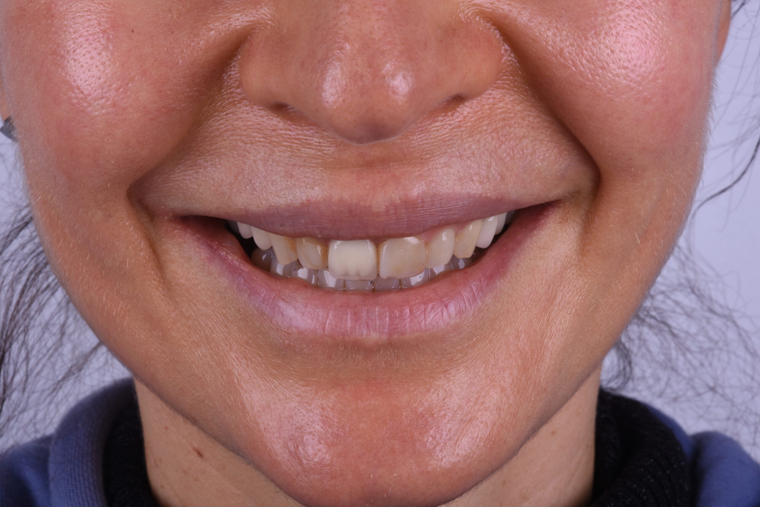 Antes del tratamiento