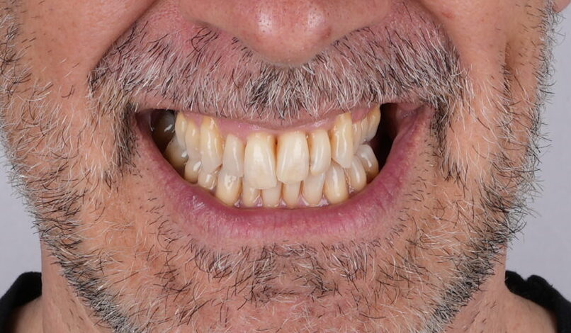 Antes del tratamiento