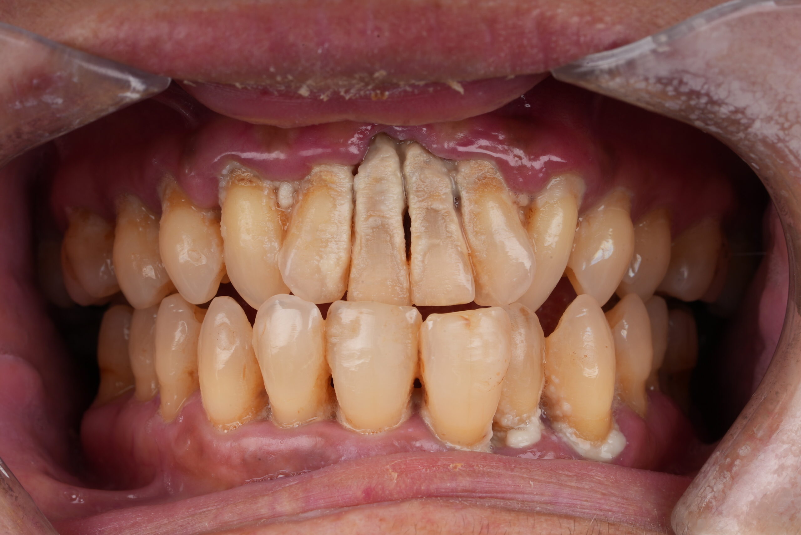 Antes del tratamiento