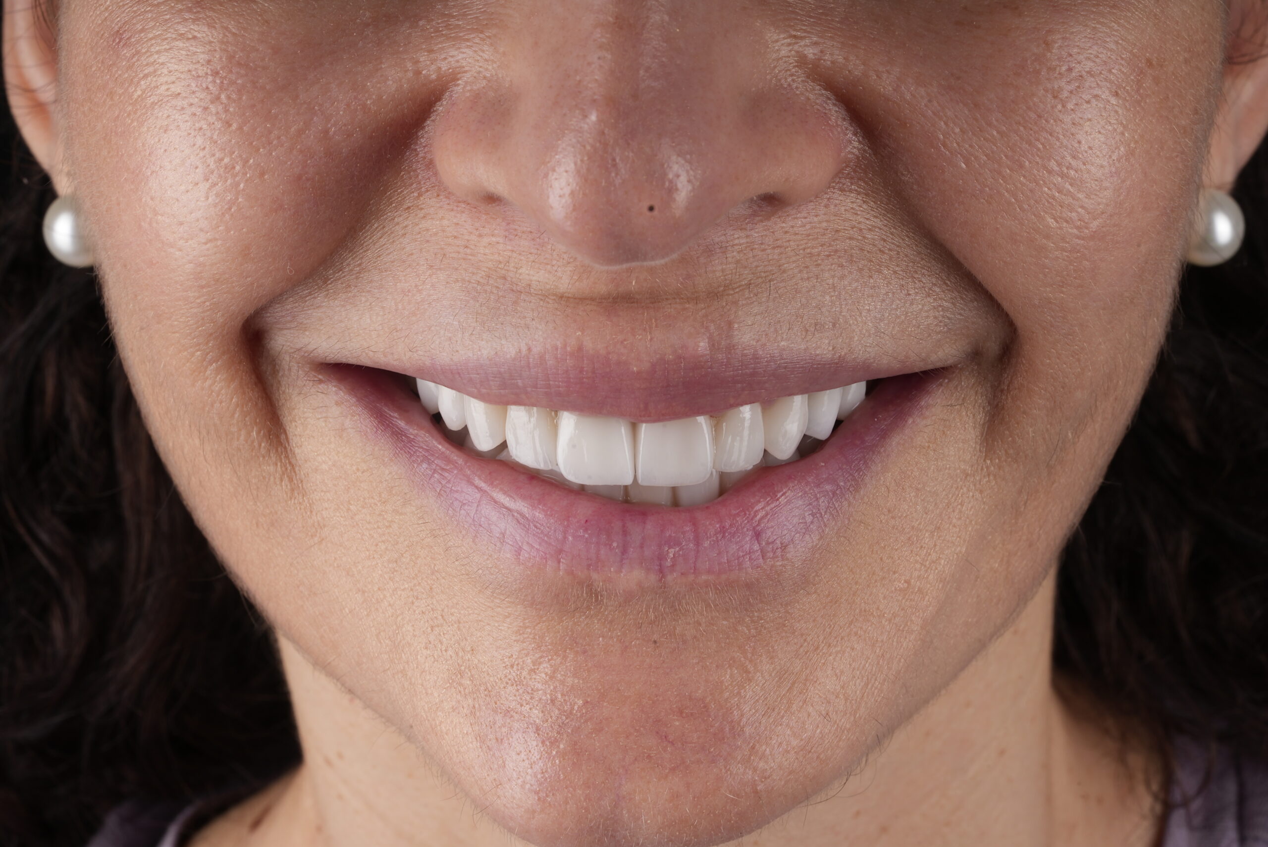 Sorriso depois do tratamento