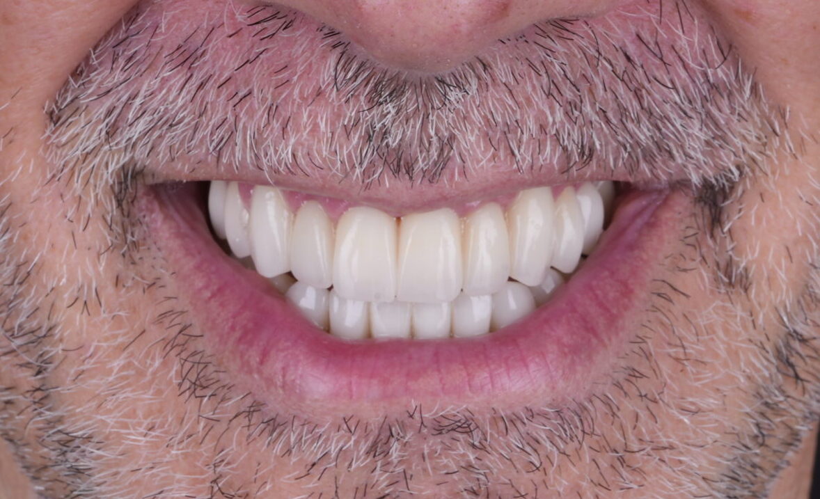 Sorriso depois do tratamento