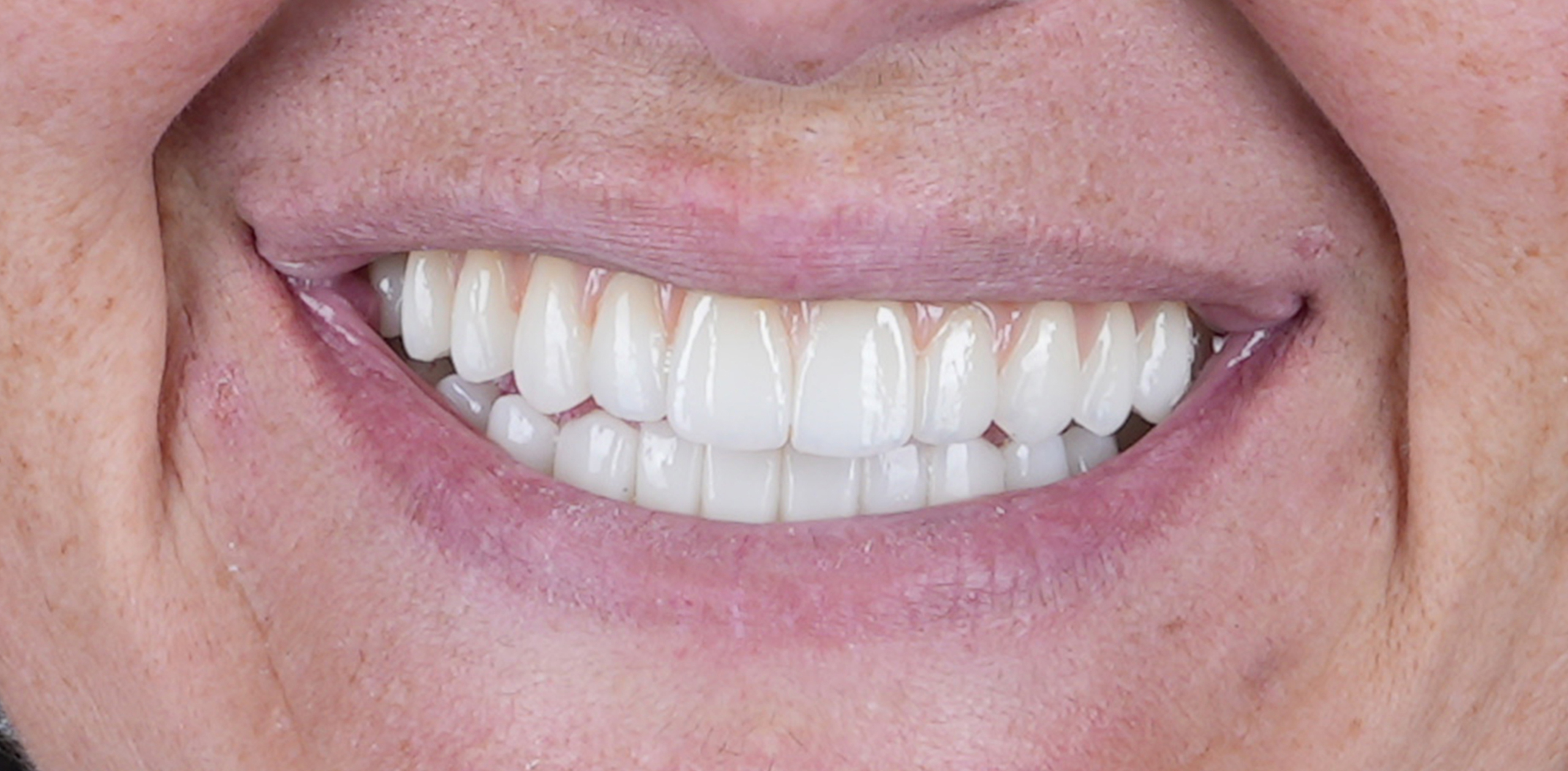 Sorriso depois do tratamento