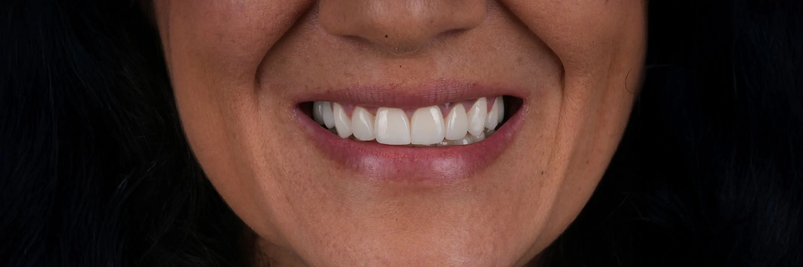 Sorriso depois do tratamento