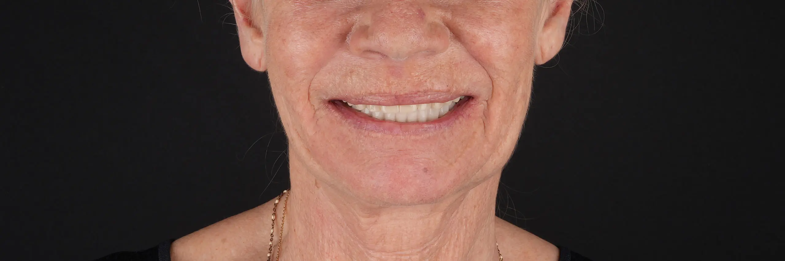 Sorriso depois do tratamento