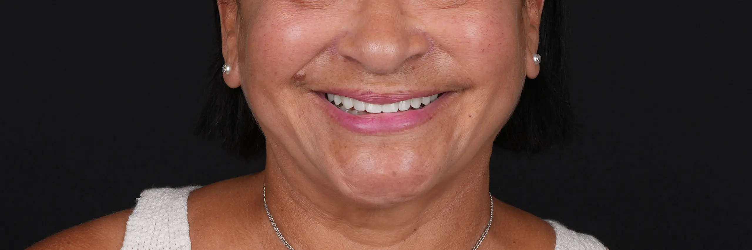 Sorriso depois do tratamento