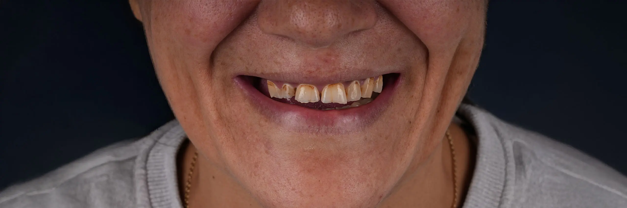 Antes del tratamiento