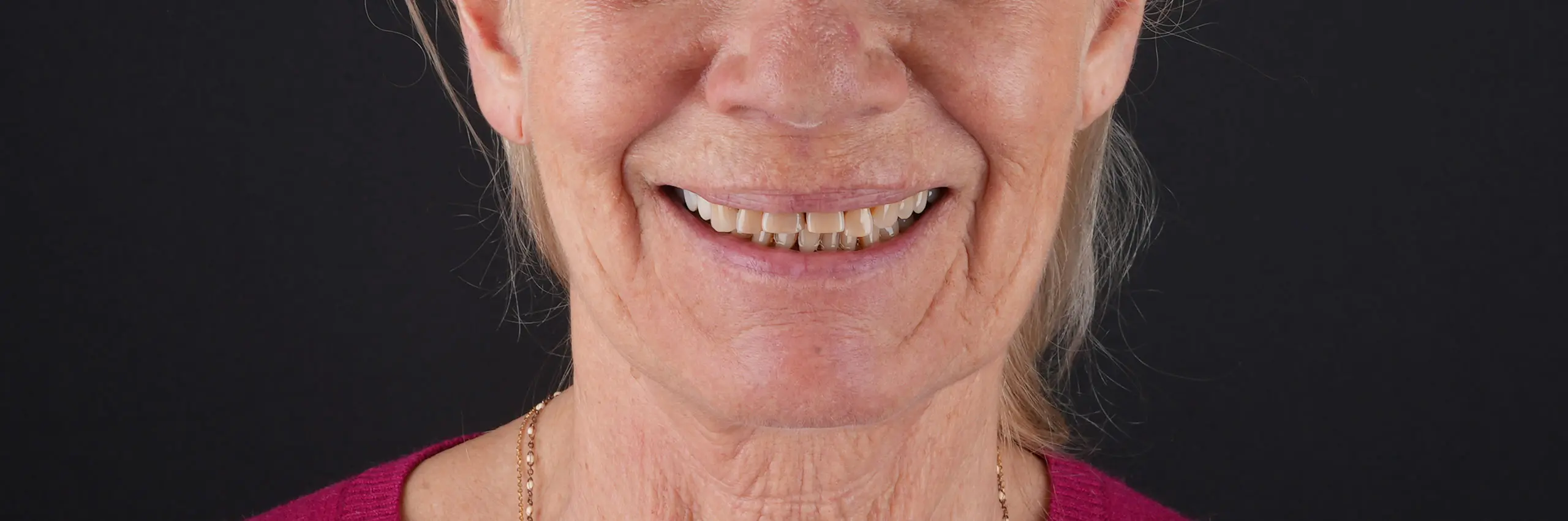 Antes del tratamiento