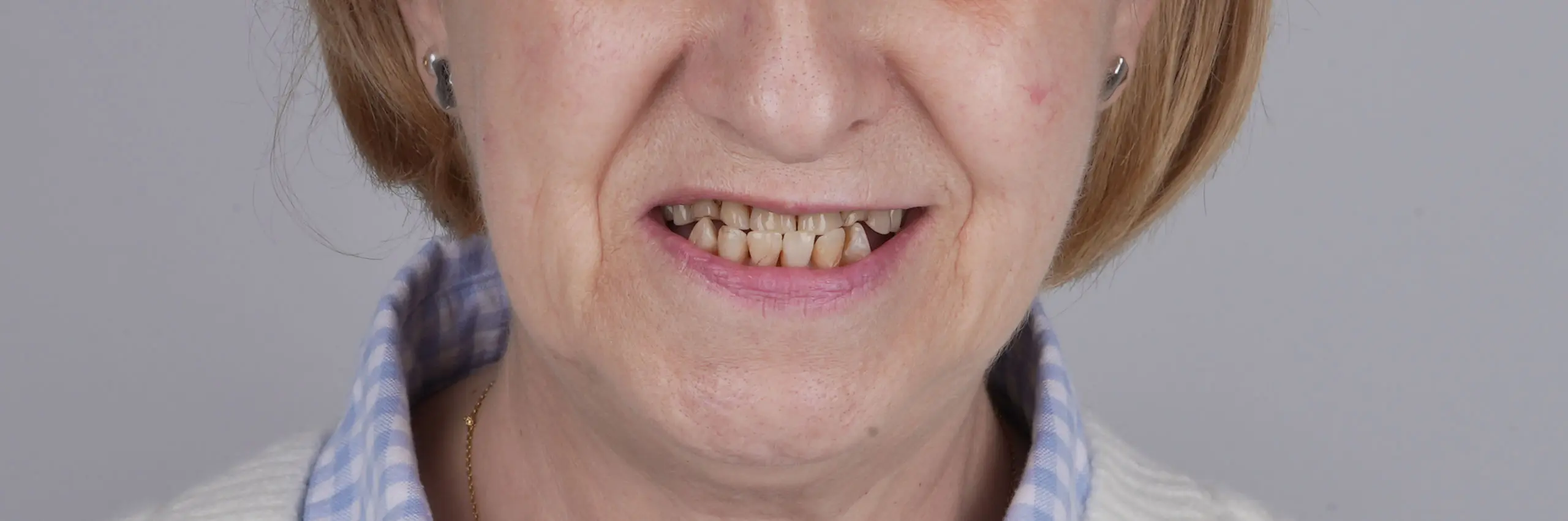 Antes del tratamiento