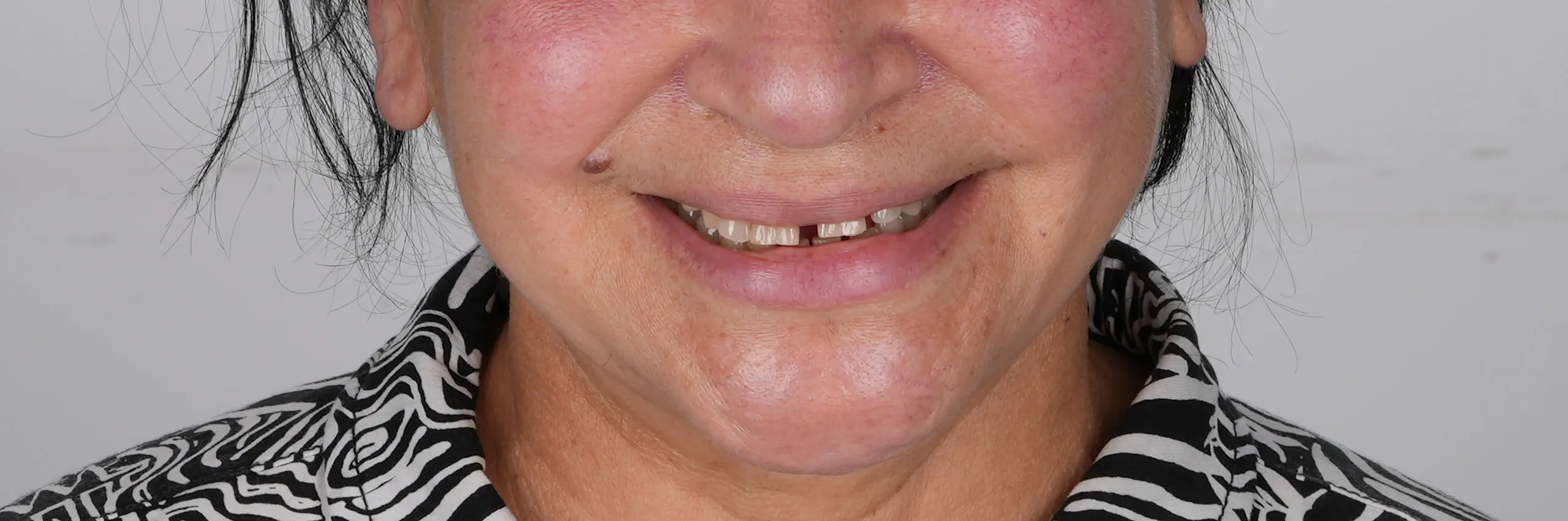 Antes del tratamiento